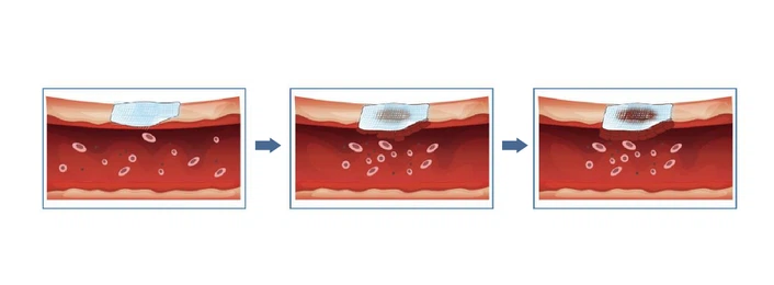 oxidized-cellulose-dressing oxidized-cellulose-dressing